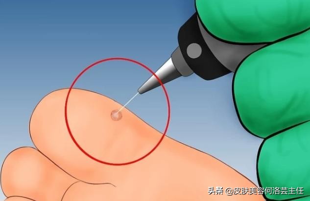 皮肤疣的描述,皮肤疣的中医治疗方法