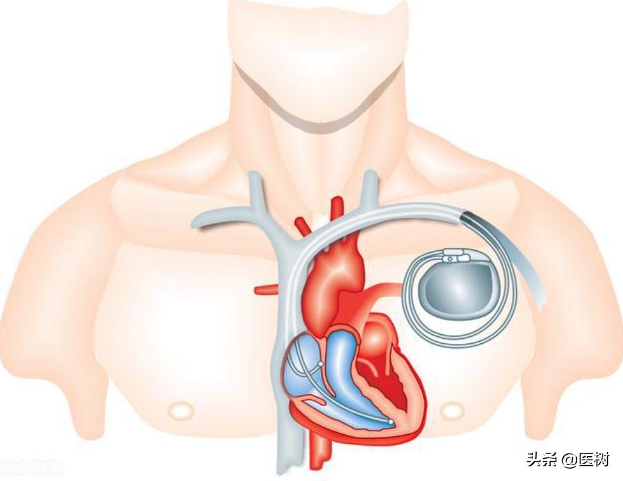 心电图t波改变是冠心病吗,心电图报告t波改变是冠心病吗