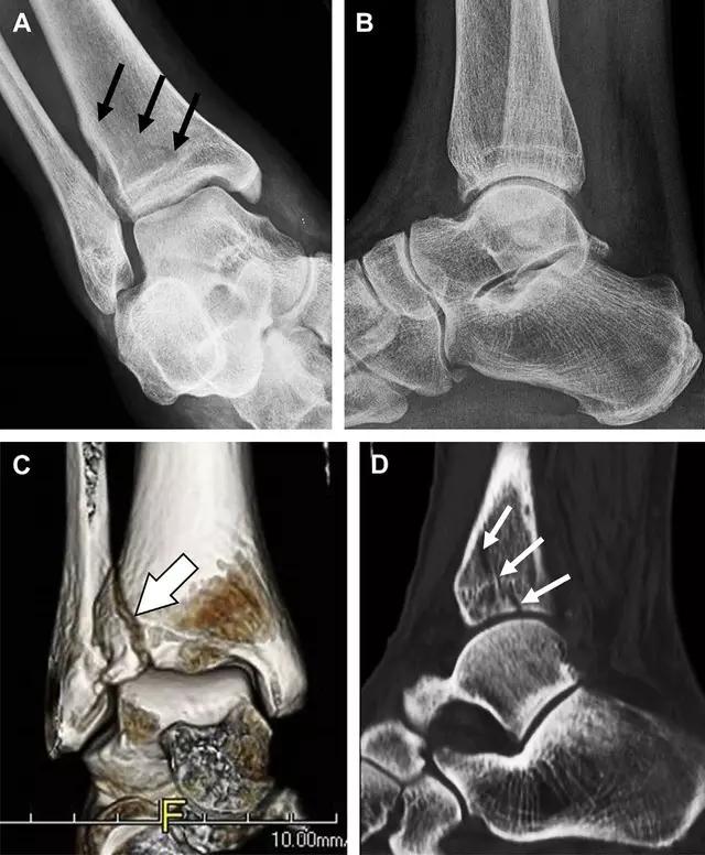 所有骨折都叫什么名字,骨折的名称有哪些