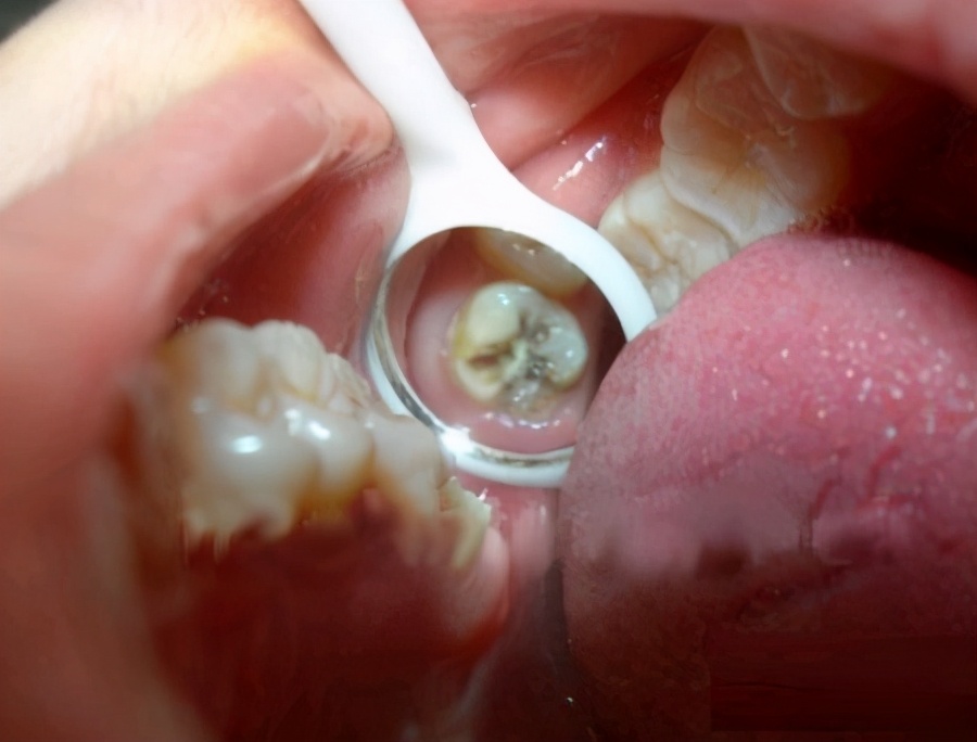 这些都能导致严重的牙疼，可以这样治疗？#雅悦齿科#