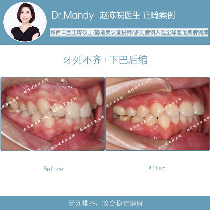 杭州牙齿隐形矫正,杭州成人隐形矫正牙齿优惠