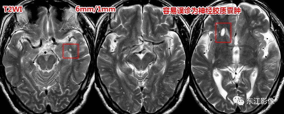头颅mri扫描影像哪里找,头颅影像mra详细解说