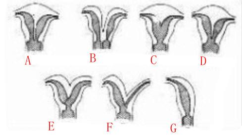 反复着床失败，看看八种异样子宫，妊娠难度是否难倒了你？