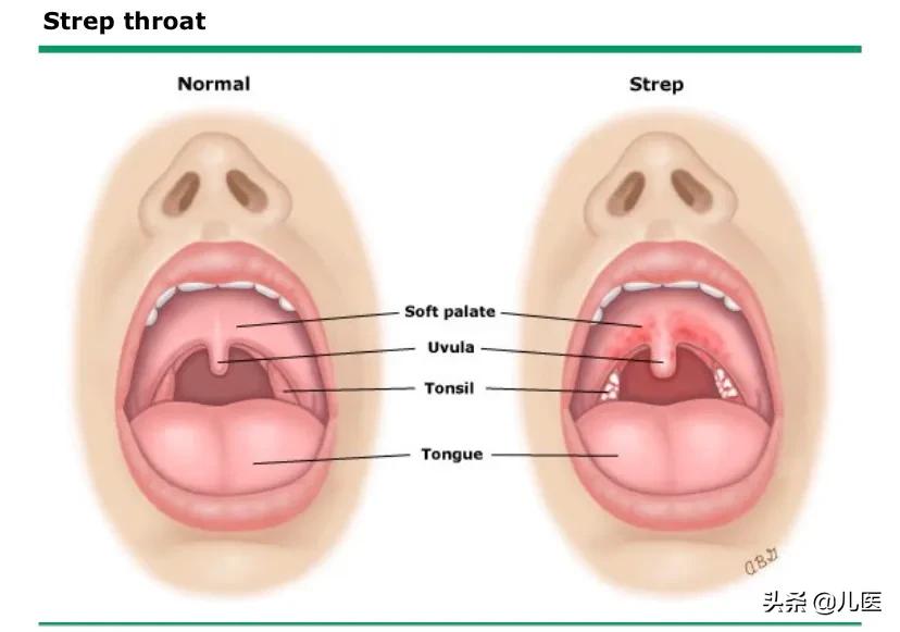 小孩嗓子发炎疼怎么办,嗓子经常发炎疼痛怎么回事