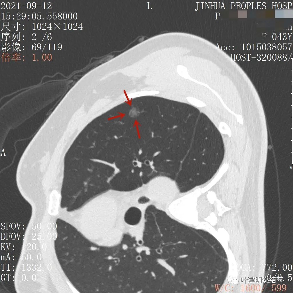怎样从病理报告看是不是原位癌,原位腺癌切除子宫要开刀吗