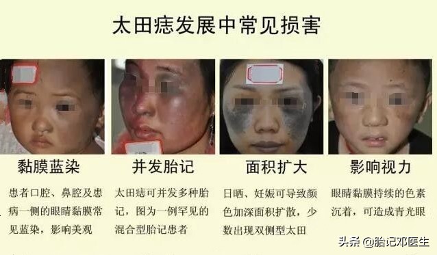 太田痣彻底治愈的效果,太田痣什么时候治疗最合适