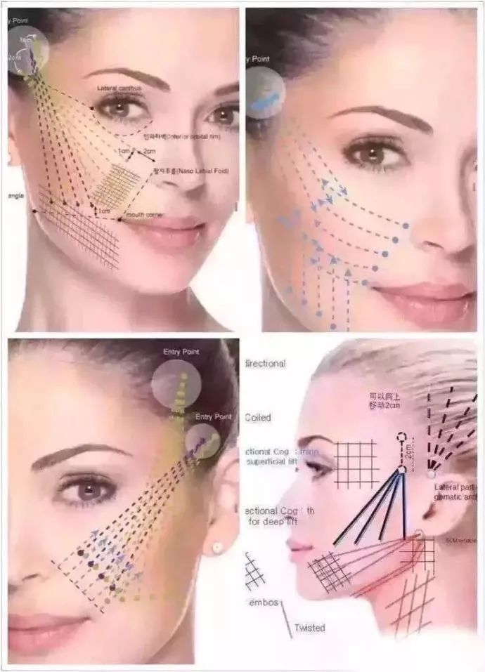 线雕热玛吉拉皮超声刀的区别,热玛吉超声刀线雕后遗症有多严重