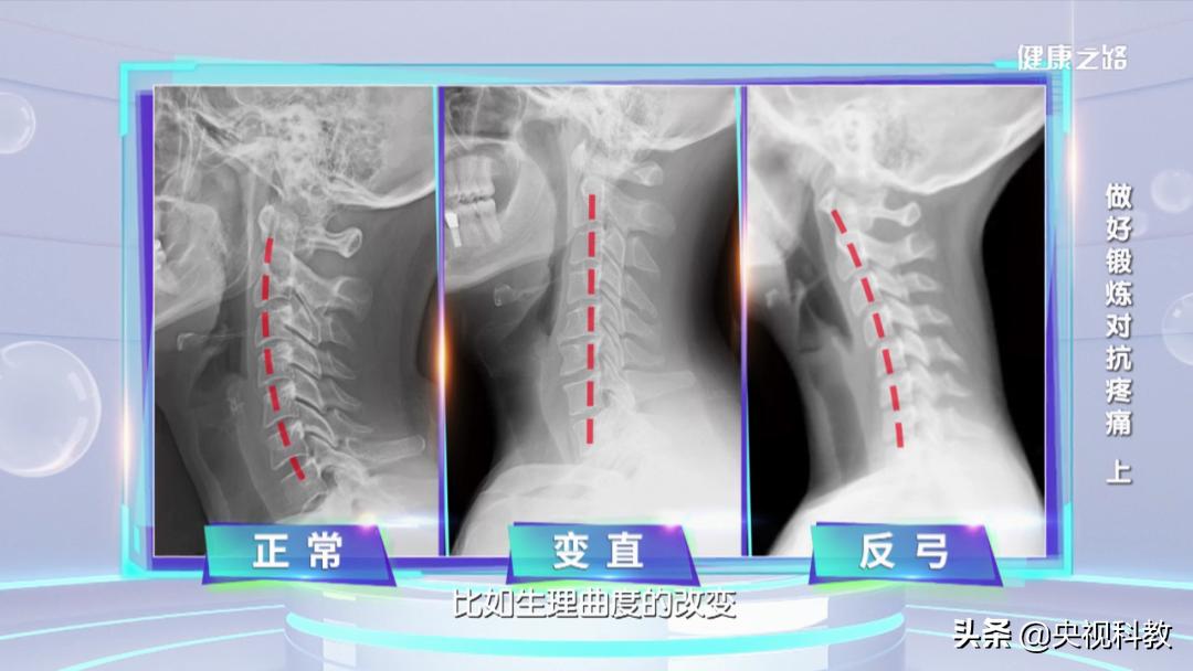颈痛缓解动作,颈不舒服什么动作可以缓解