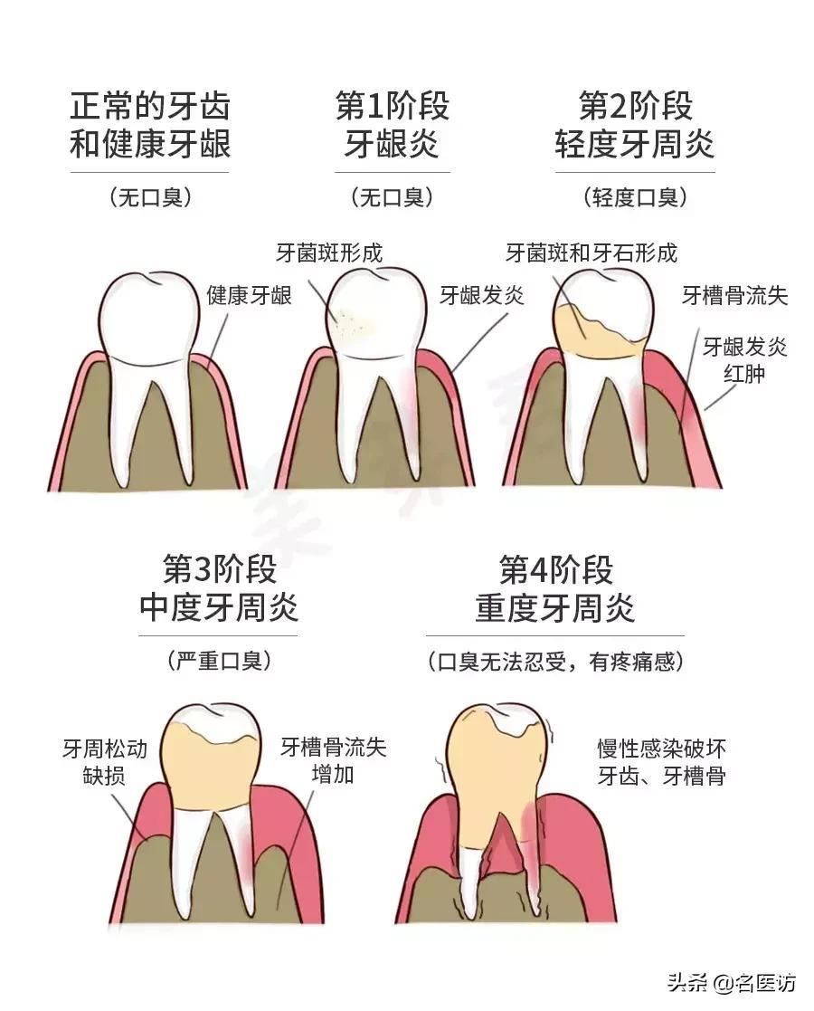 洗牙攻略,洗牙全攻略