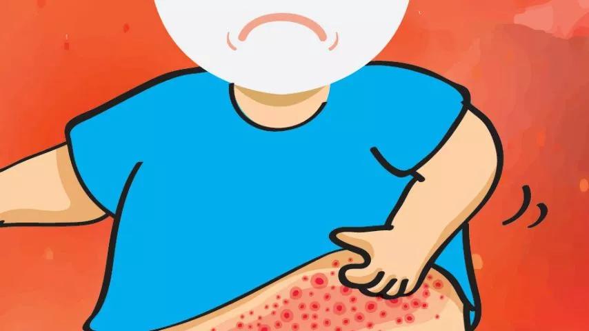 抑菌乳膏治疗皮肤痒,皮肤科常用的止痒软膏有哪些