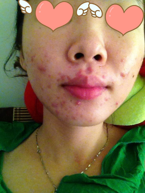 月球脸如何改善,月球脸修复最佳方法