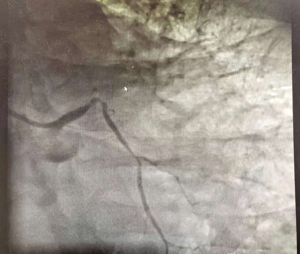 胃痛一个月后突发心梗,大夫心梗误诊胃病致死