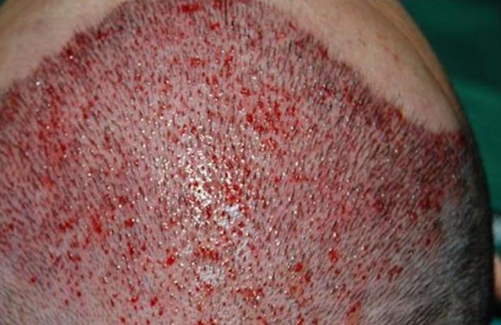 植发七天清理血痂后表面有水珠,植发清理血痂最好的方法