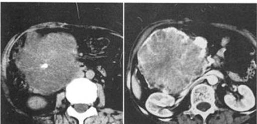 胰腺有哪些罕见病,胰腺上面最容易长的啥东西