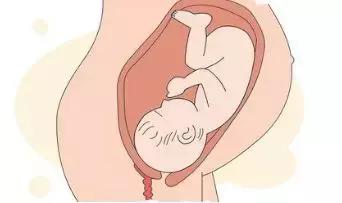 怀孕胎位不正用手正胎位,rop胎位是胎位不正吗