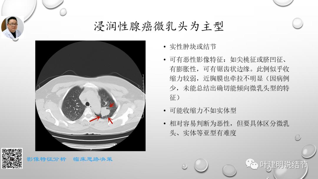 叶建明谈肺实性小结节视频,廖正银教授谈肺结节