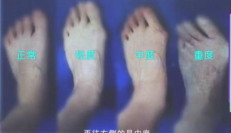 怎么选择适合自己脚型的鞋,怎样选一款适合自己脚型的鞋