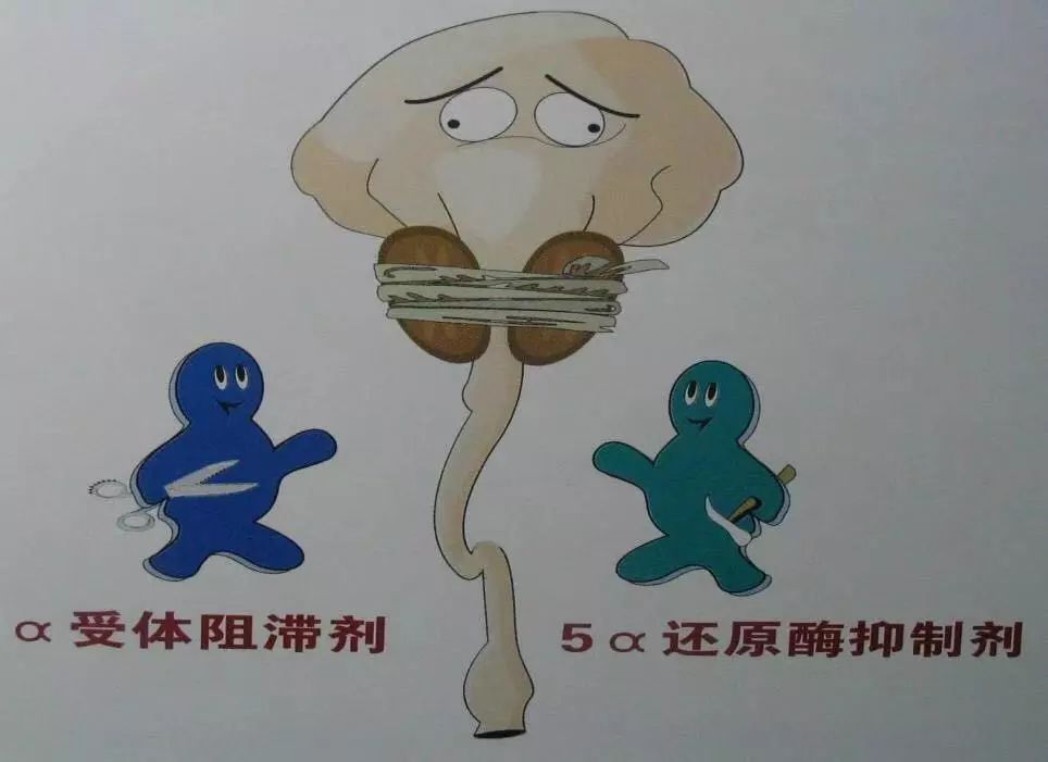 糖尿病患者得了前列腺增生怎么办,糖尿病尿多与前列腺增生尿多区别