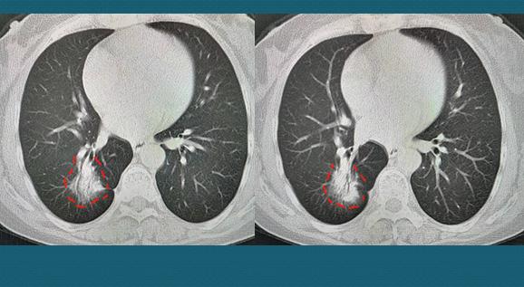 31岁肺癌自愈案例,三十岁肺癌晚期