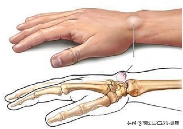 更年期女性为什么会得腱鞘炎,女性腱鞘炎怎么治疗效果最好