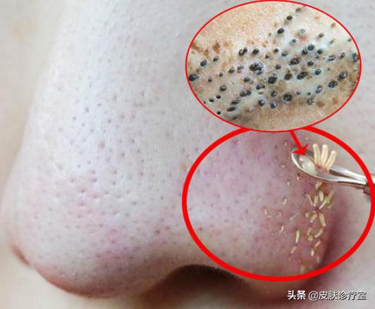 女生毛孔粗大全脸,90岁女人毛孔粗怎么办