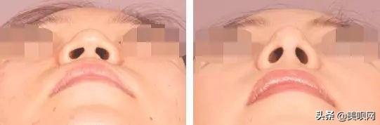 明星都在用的缩小鼻翼神器,明星鼻子做鼻翼缩小外切