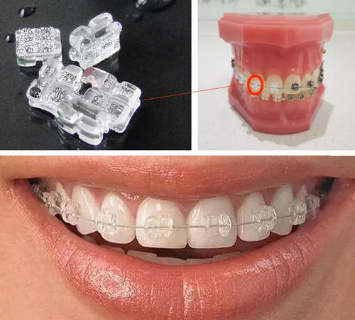 小伙相亲被弃，“大凸牙，我不要嫁给你”快三十，矫正还来得及？