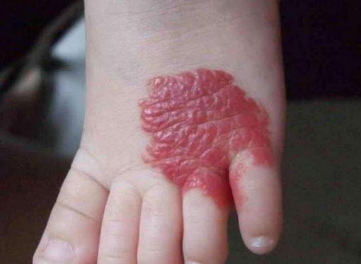 脸上血管瘤怎么引起的,脸上的血管瘤是怎么形成的