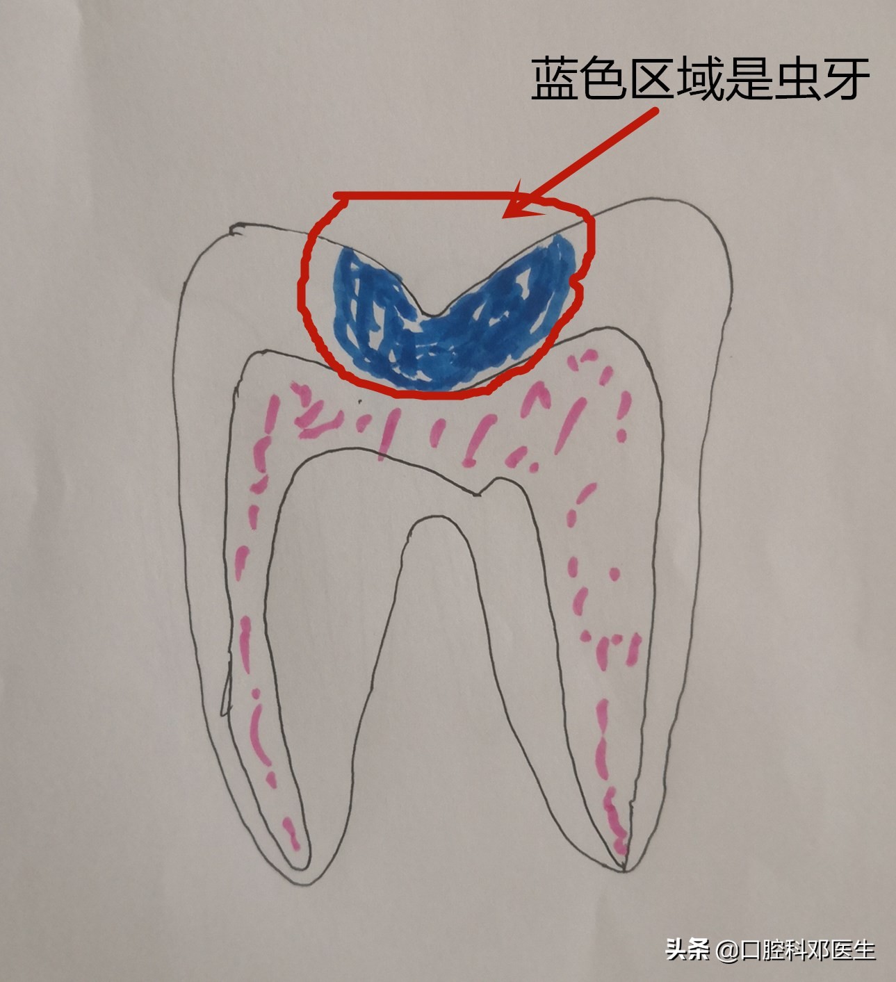 虫牙不及时补有什么后果,虫牙不治疗直接补能管多久
