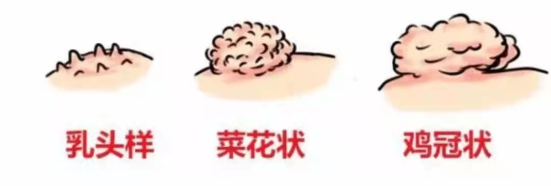 尖锐性湿疣一直反复怎么办,尖锐性湿疣反反复复怎么办