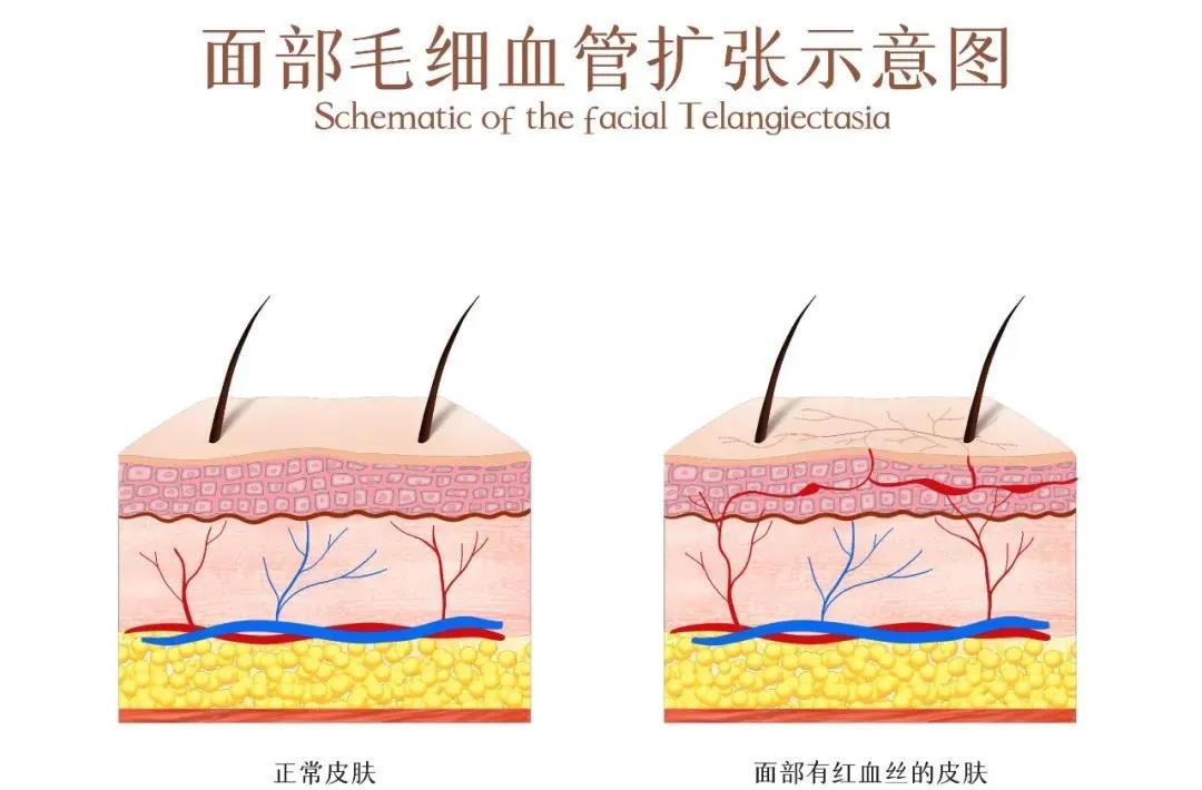 让人羞红脸是什么原因,红脸蛋到底是什么皮肤