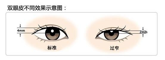 是不是做了双眼皮眉眼间距会变近,是不是双眼皮越宽眼越大