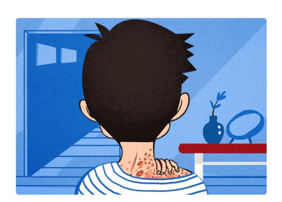 脓疱型银屑病患者的护理,泛发性脓疱型银屑病的治疗和预防