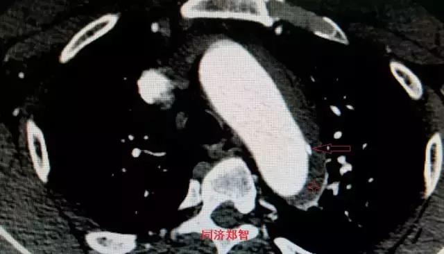 磁共振可以替代cta检查主动脉夹层,超声心动图联合cta诊断主动脉夹层