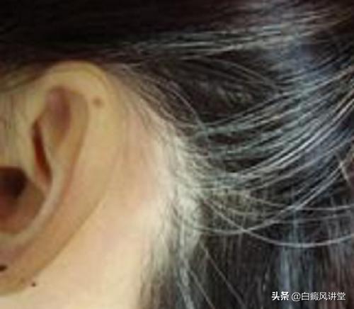 什么是毛囊型白癜风？会长满全身吗？它的发病原因是啥？