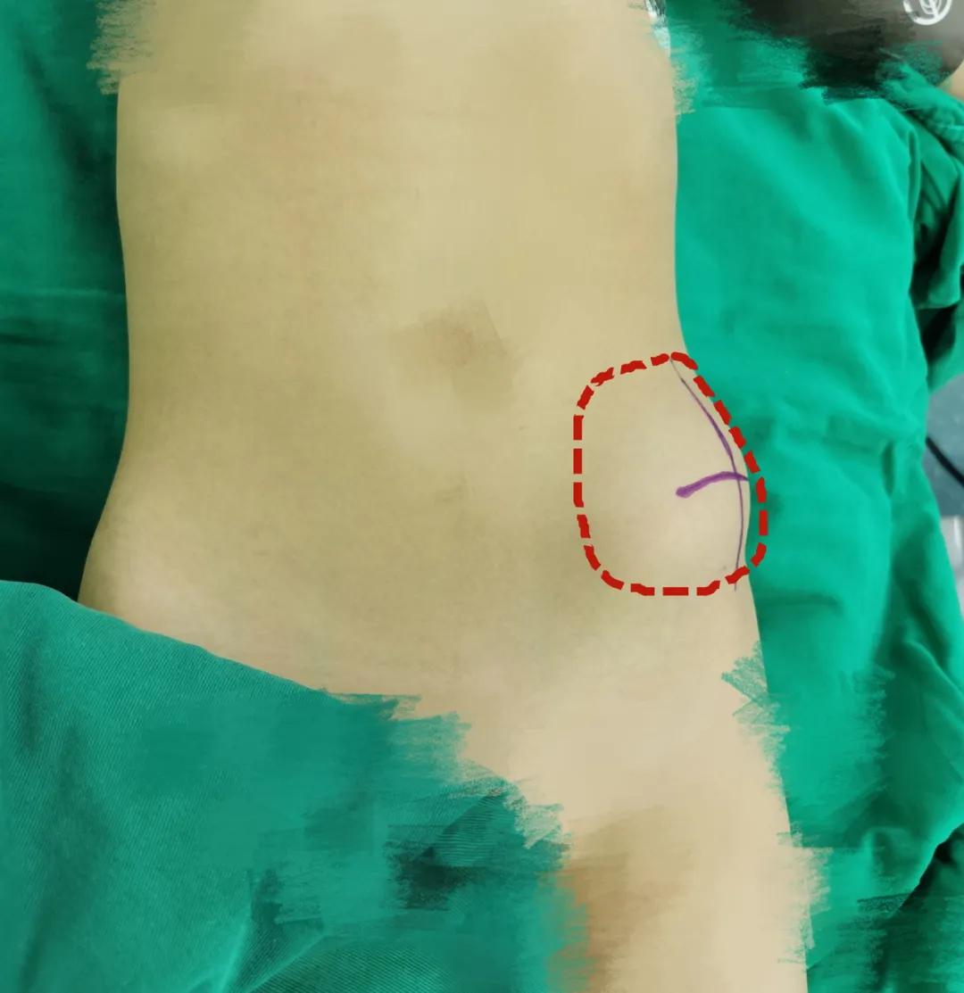 孩子胯骨处长了一个硬疙瘩,小孩胯部肉里长疙瘩怎么回事