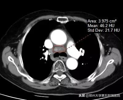 癌症脑转移伽玛刀后遗症,癌症病人接受伽玛刀治疗