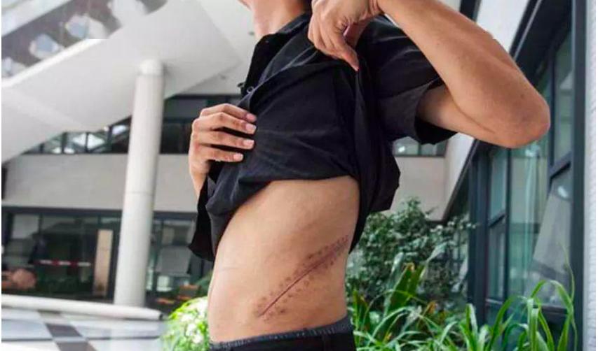 尼泊尔“卖肾村”：穷人700美元卖一个肾，人人身上一道疤