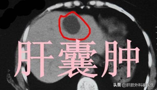 体检查出肝上有血管瘤需要确诊吗,体检查出肝血管瘤要不要紧