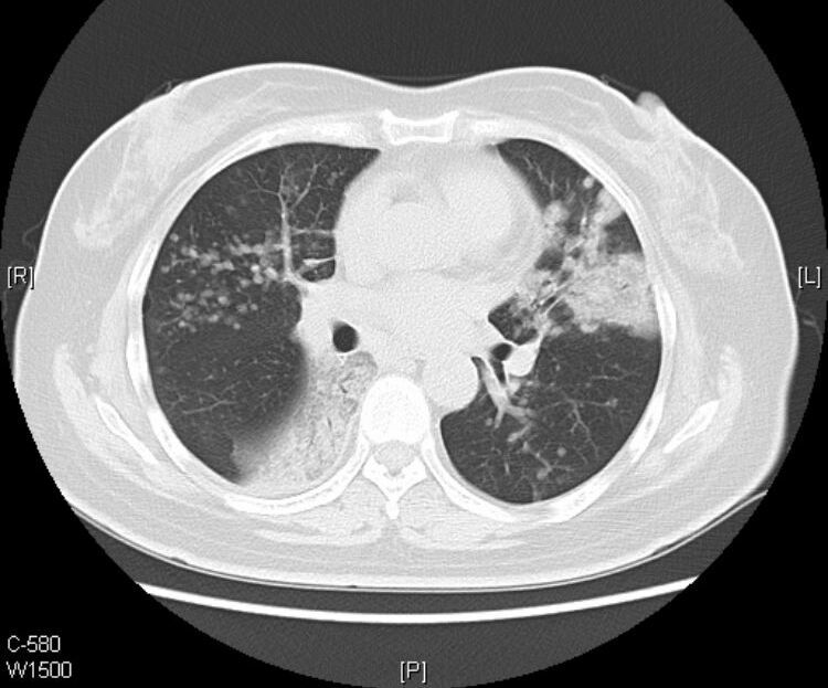 黏液腺癌基本不转移不复发,肺粘液腺癌转移了还能治好吗