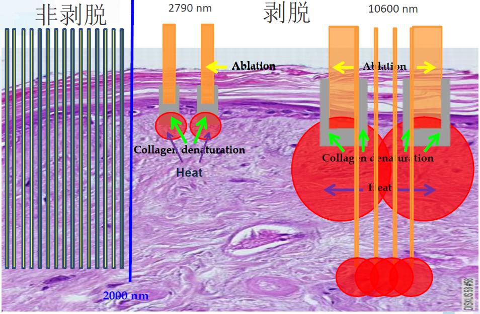 超脉冲co2点阵激光可以祛妊娠纹吗,脉冲点阵激光和co2点阵激光