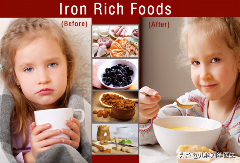 用铁锅炒菜可有效预防缺铁性贫血,儿童营养性缺铁性贫血的干预措施