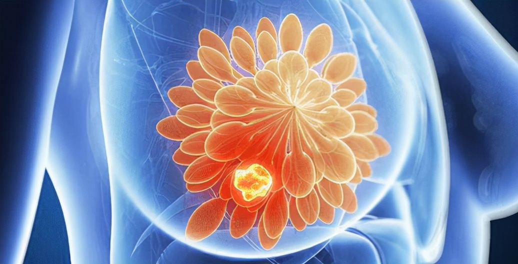 检查结果右乳低回声是怎么回事