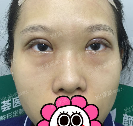 原来双眼皮不好看有必要继续割吗,割双眼皮是不是越修复越难看