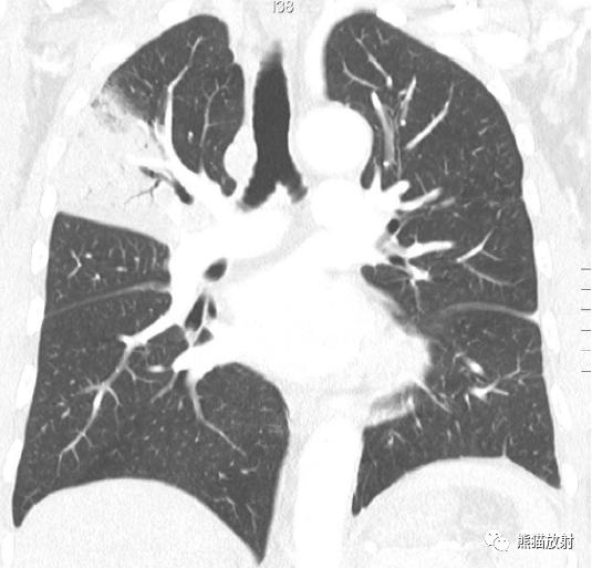 肺部感染并发症,老人新冠引起肺部并发症