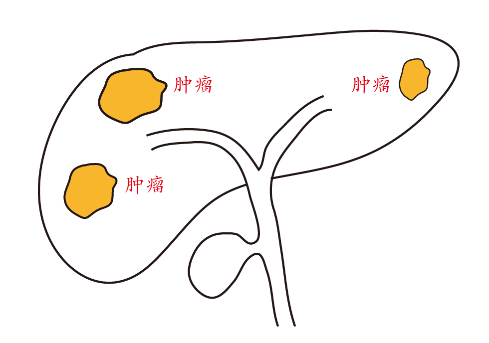 槐耳颗粒治疗肝癌多久见效,槐耳颗粒治疗肝癌的效果如何