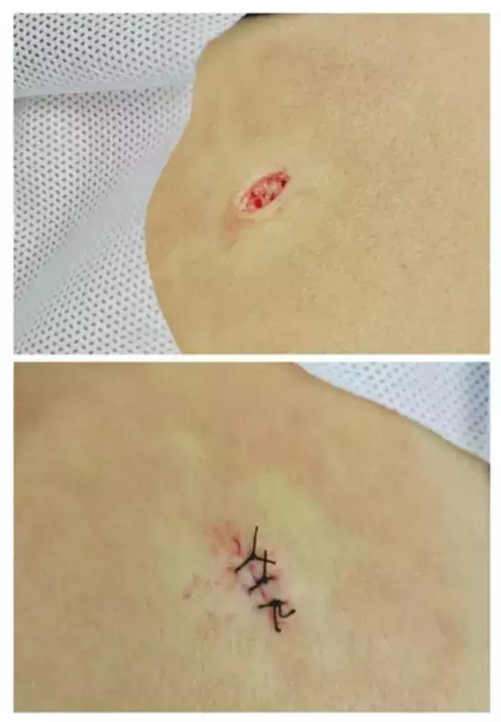 瘢痕体质如果要动手术怎么办,不太严重的疤痕体质能做手术吗