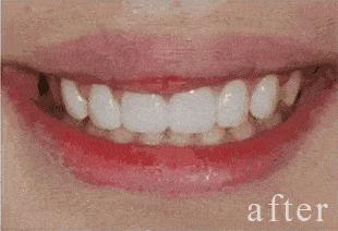 牙齿美白去黄的最快方法,什么牙膏美白牙齿去黄最好