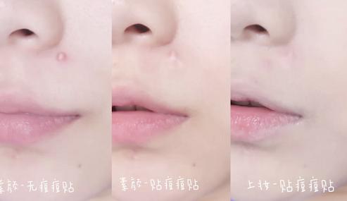 片仔癀净痘修护贴,抗痘贴片仔癀