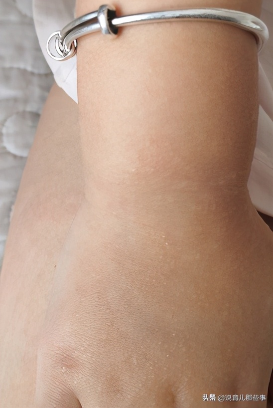 很恐怖的过敏图片,过敏发朋友圈的真实图片